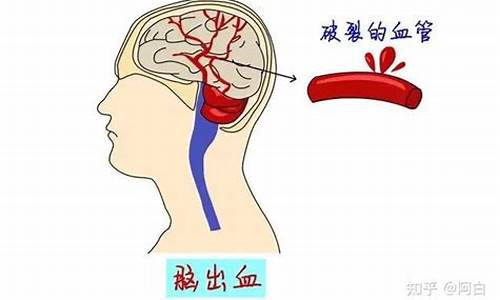 高考高出30分脑溢血_高考生查成绩激动到脑出血